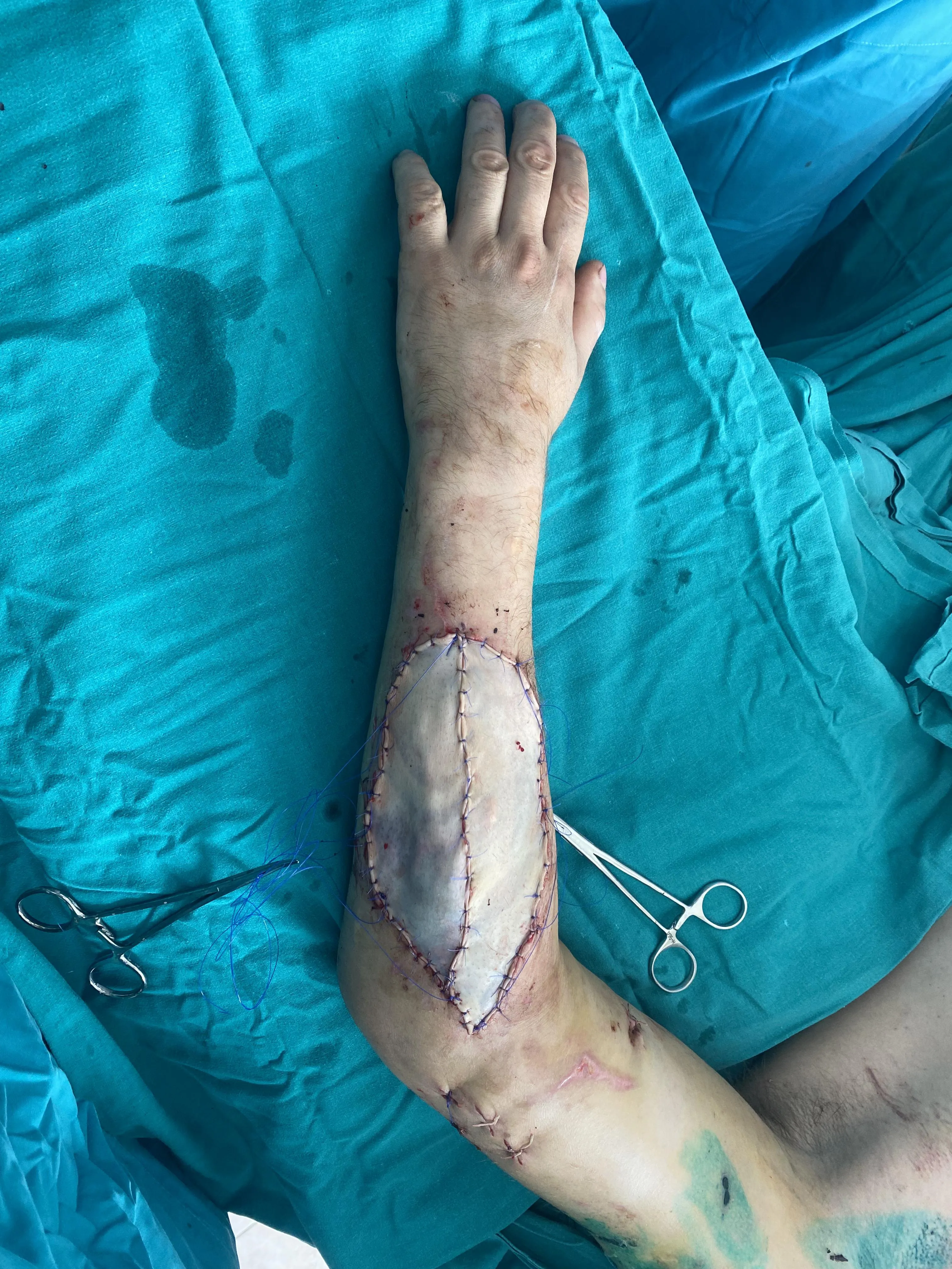 Пластика мягких тканей при травмах